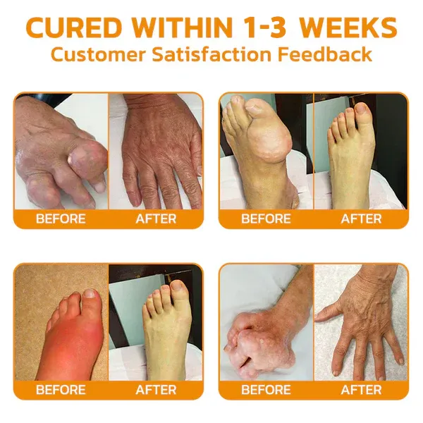 🔥❤️‍🔥Flysmus™ Bee Venom Pain-Relief Bone Healing Cream(Specially for older adults & TGA recommends)