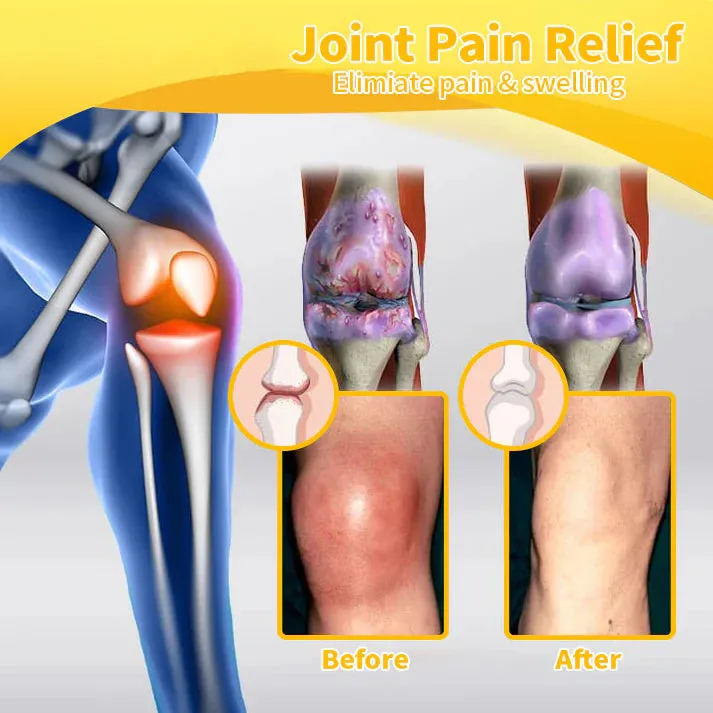 🔥❤️‍🔥Flysmus™ Bee Venom Pain-Relief Bone Healing Cream(Specially for older adults & TGA recommends)